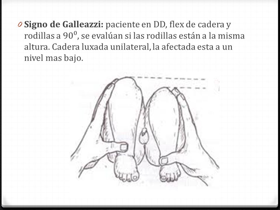 Signo de Galleazzi: paciente en DD, flex de cadera y rodillas a 90⁰, se evalúan si las rodillas están a la misma altura.