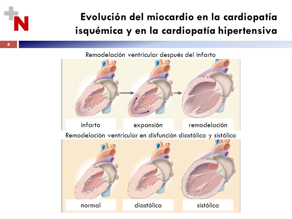 Evolución del miocardio en la cardiopatía isquémica y en la cardiopatía hipertensiva