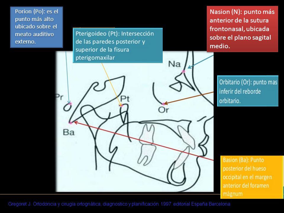 Porion (Po): es el punto más alto ubicado sobre el meato auditivo externo.