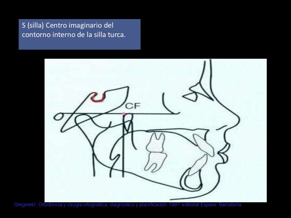 GregoretJ. Ortodoncia y cirugía ortognática, diagnostico y planificación.
