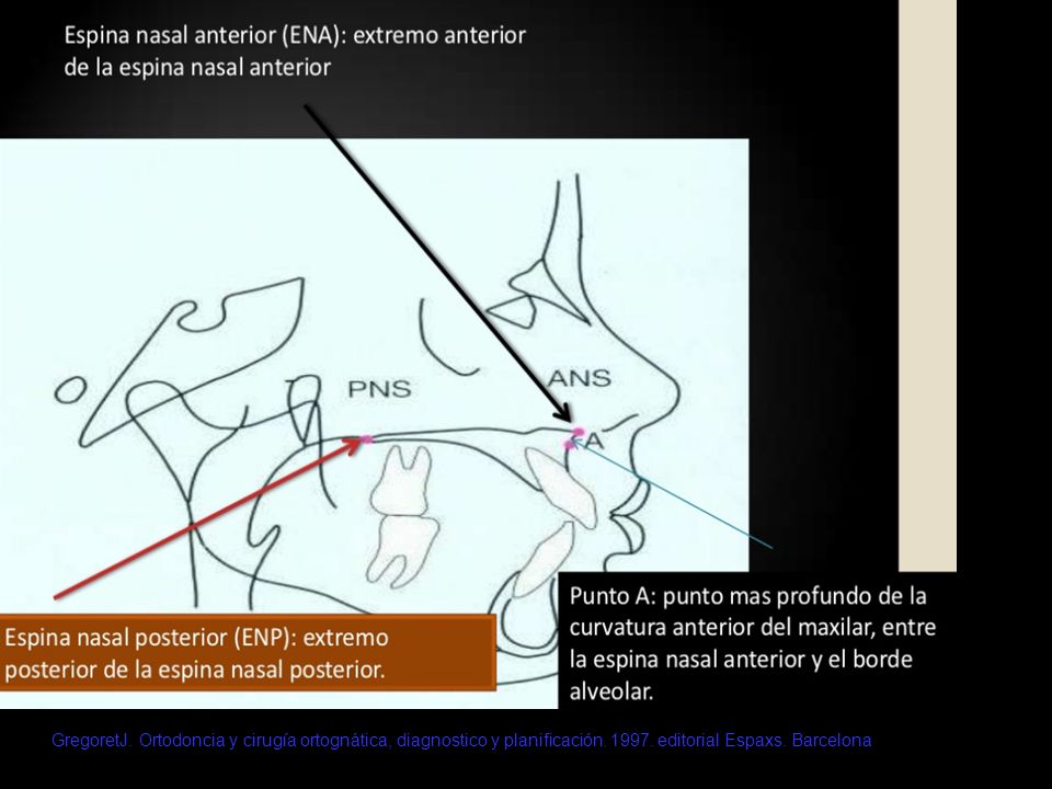 GregoretJ. Ortodoncia y cirugía ortognática, diagnostico y planificación.