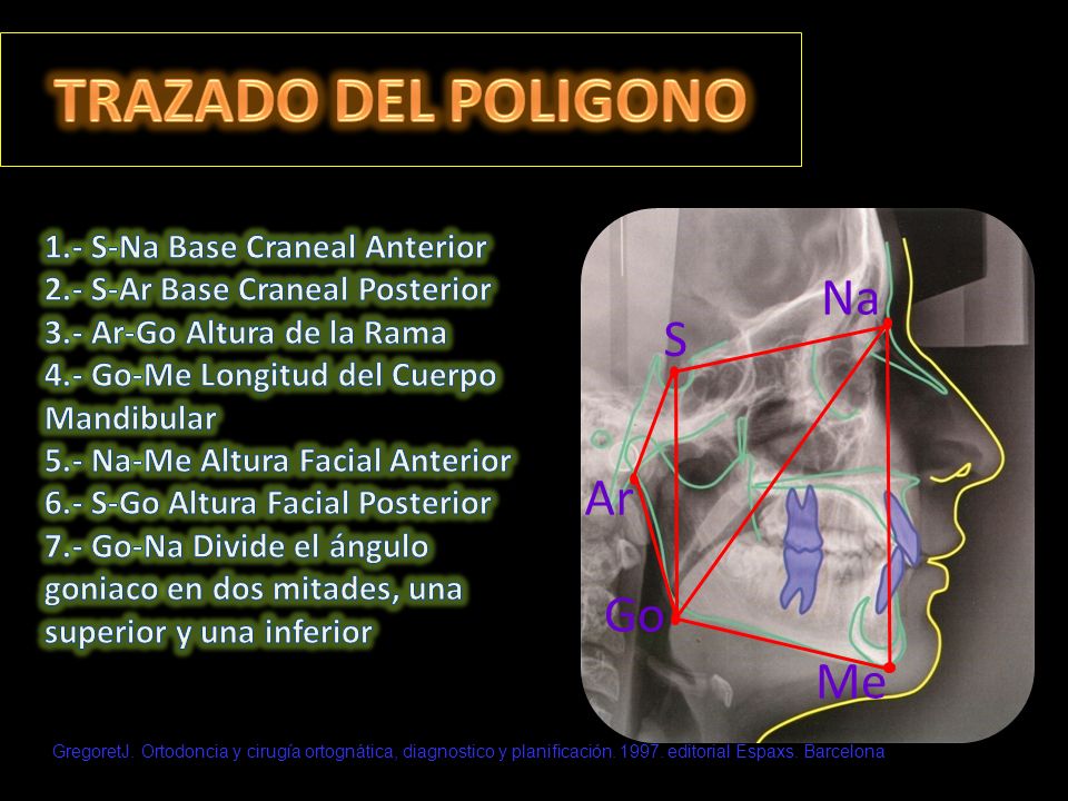 TRAZADO DEL POLIGONO Na S Ar Go Me 1.- S-Na Base Craneal Anterior