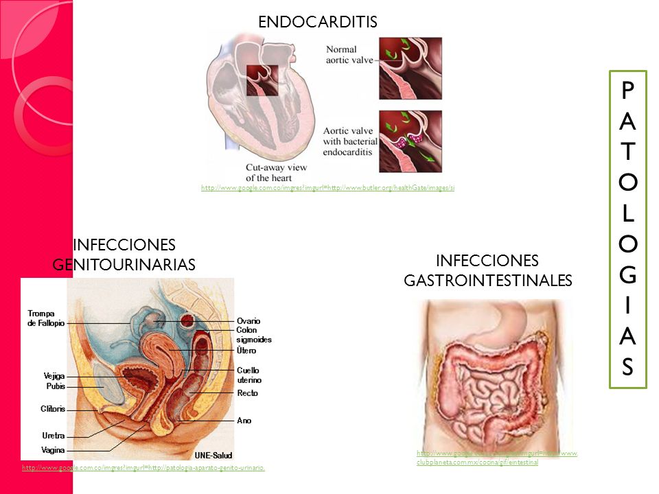 P A T O L G I S ENDOCARDITIS INFECCIONES GENITOURINARIAS