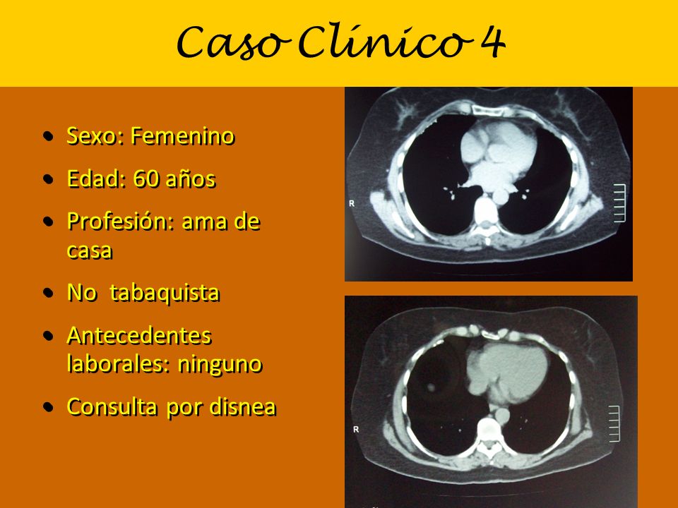 Caso Clínico 4 Sexo: Femenino Edad: 60 años Profesión: ama de casa