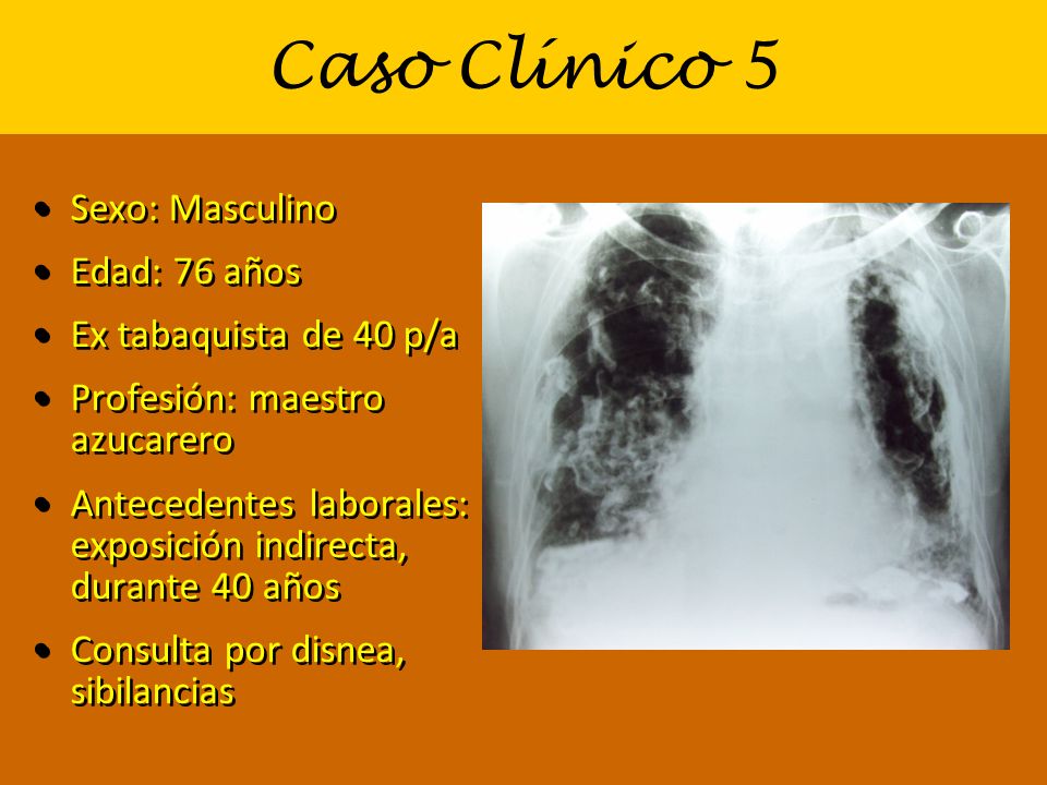 Caso Clínico 5 Sexo: Masculino Edad: 76 años Ex tabaquista de 40 p/a