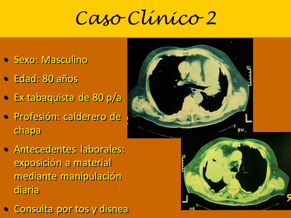 Caso Clínico 2 Sexo: Masculino Edad: 80 años Ex tabaquista de 80 p/a