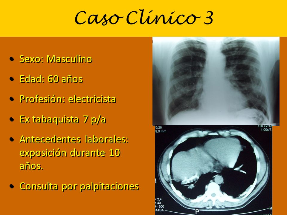 Caso Clínico 3 Sexo: Masculino Edad: 60 años Profesión: electricista
