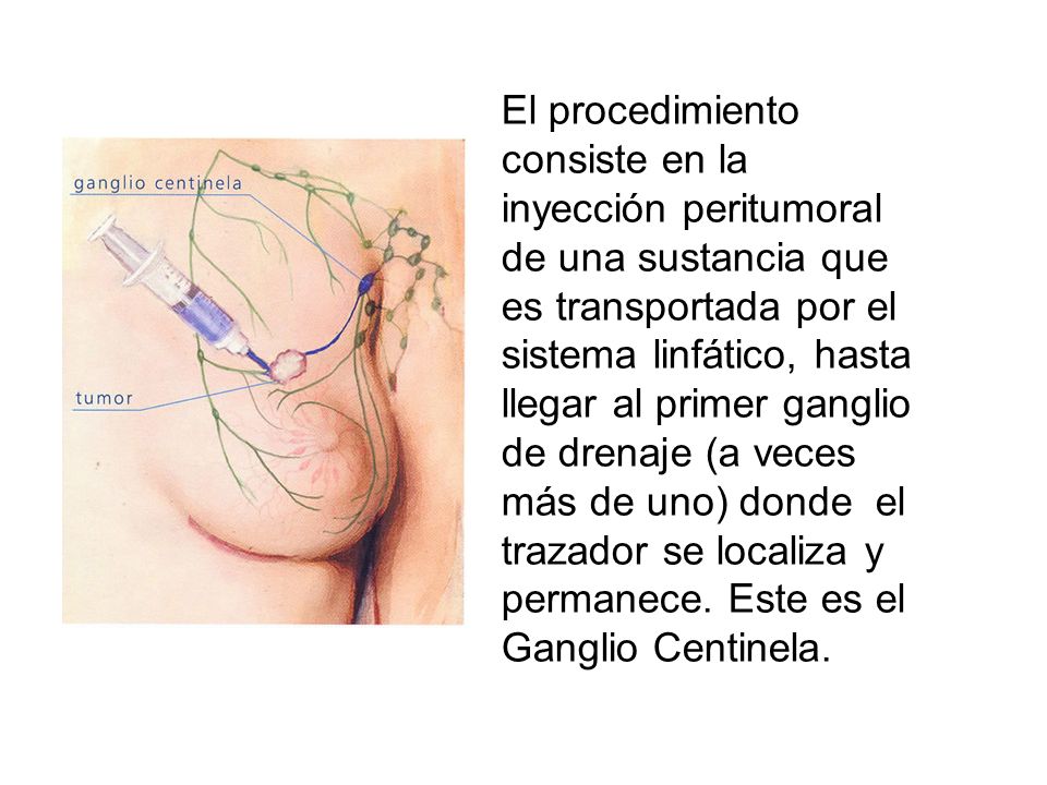 El procedimiento consiste en la inyección peritumoral de una sustancia que es transportada por el sistema linfático, hasta llegar al primer ganglio de drenaje (a veces más de uno) donde el trazador se localiza y permanece.