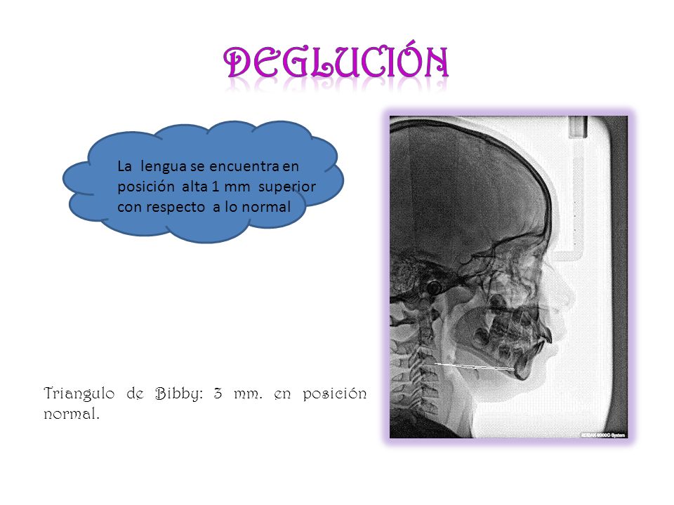 Deglución La lengua se encuentra en posición alta 1 mm superior con respecto a lo normal.