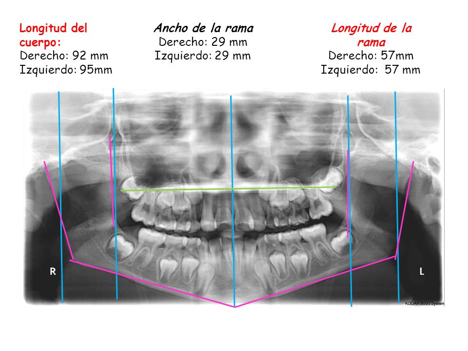 Ancho de la rama Derecho: 29 mm Izquierdo: 29 mm