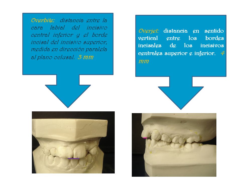 Overbite: distancia entre la cara labial del incisivo central inferior y el borde incisal del incisivo superior, medida en dirección paralela al plano oclusal. 3 mm