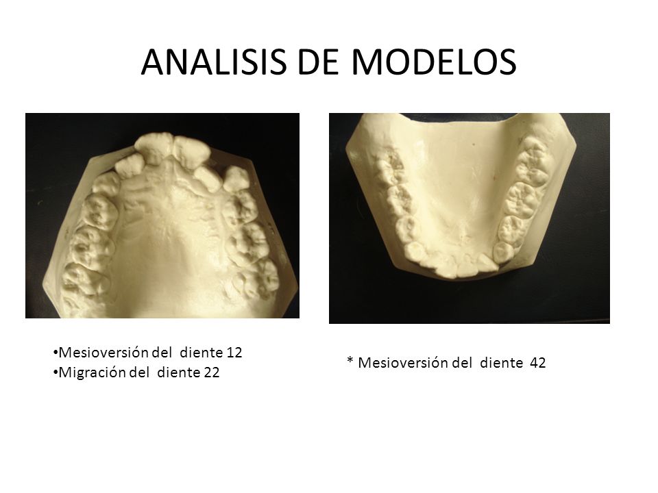 ANALISIS DE MODELOS Mesioversión del diente 12 Migración del diente 22