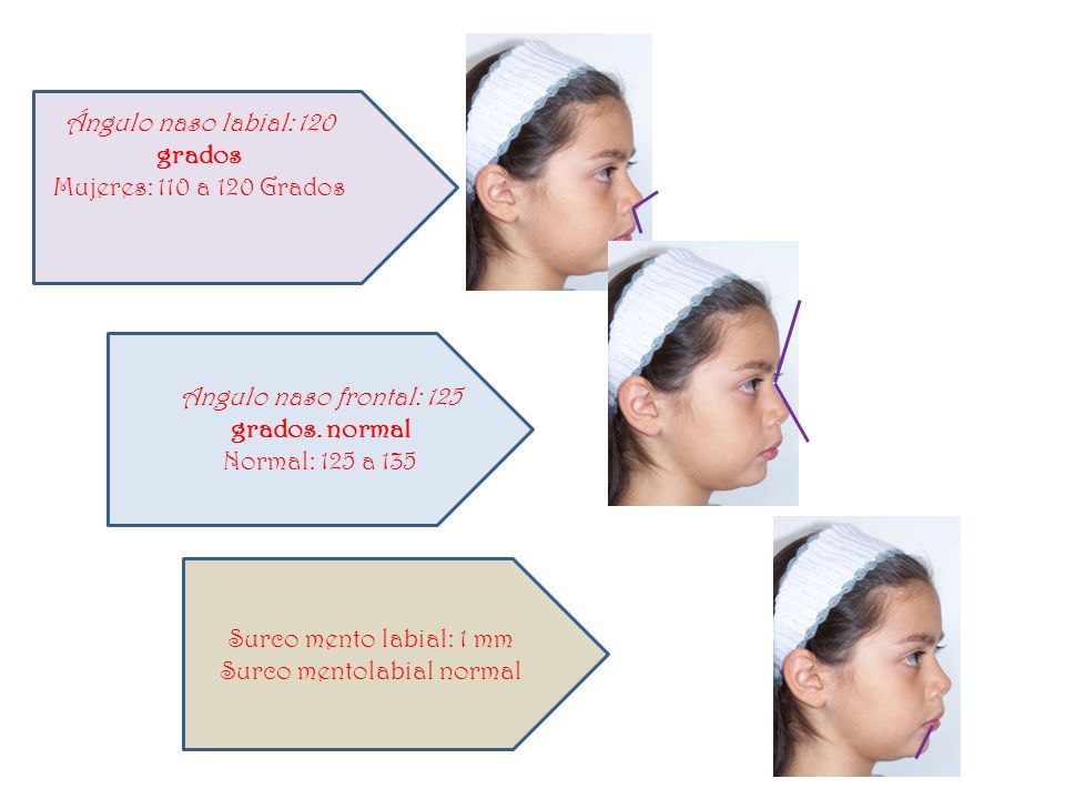 Ángulo naso labial: 120 grados Mujeres: 110 a 120 Grados