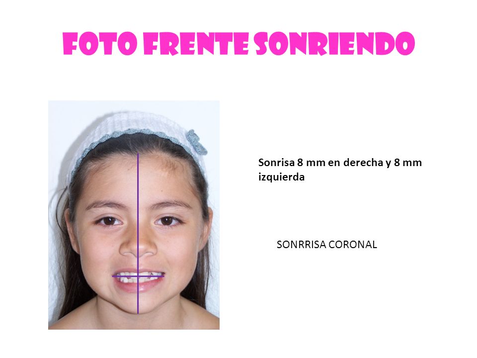 FOTO FRENTE SONRIENDO Sonrisa 8 mm en derecha y 8 mm izquierda