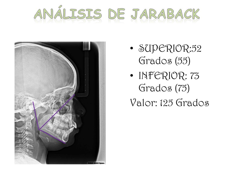Análisis de jaraback SUPERIOR:52 Grados (55) INFERIOR: 73 Grados (75)