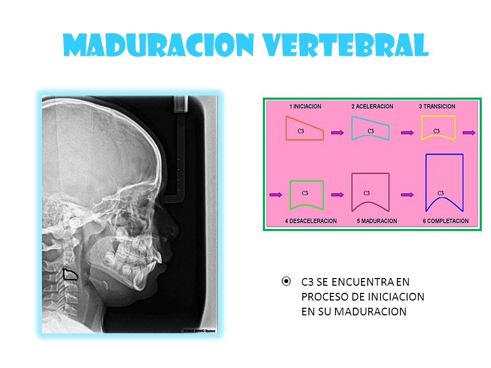 MADURACION VERTEBRAL C3 SE ENCUENTRA EN PROCESO DE INICIACION EN SU MADURACION