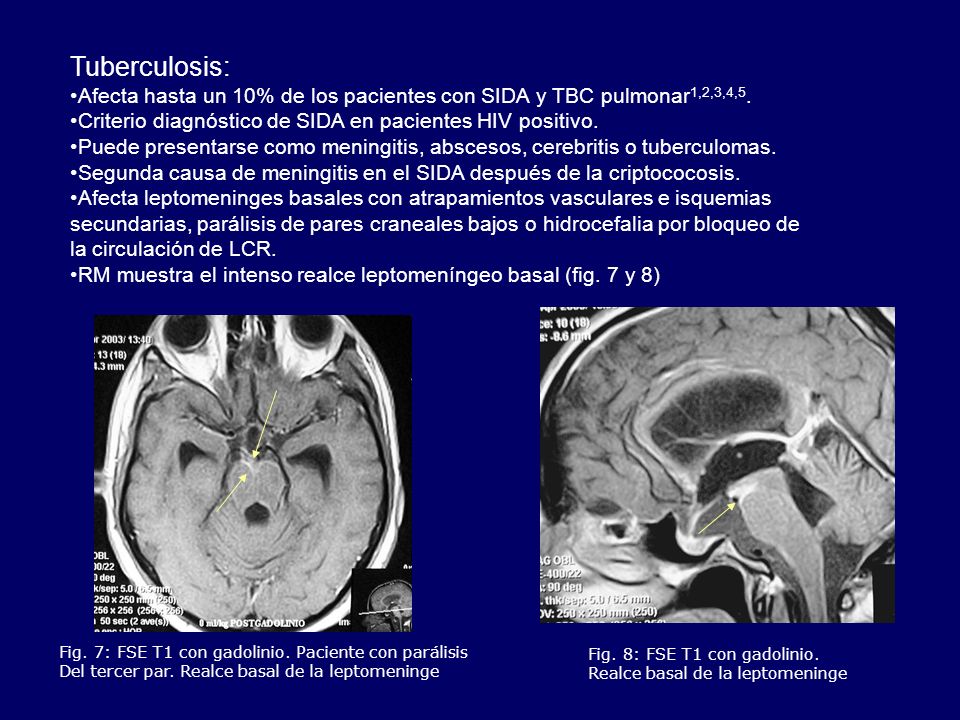 Tuberculosis: Afecta hasta un 10% de los pacientes con SIDA y TBC pulmonar1,2,3,4,5. Criterio diagnóstico de SIDA en pacientes HIV positivo.