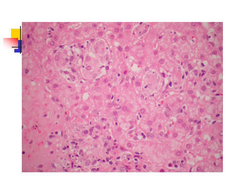 La tinción de Giemsa muestra células endoteliales, (las más teñidas ), que revisten al sinusoide. En el interior del hepatocito, que es la célula con núcleo grande y nucleolo prominente, se aprecian unos corpúsculos binucleados o gemados, de aspecto de imperdible con halo claro, que es el cuerpo de Leisman Donovan.