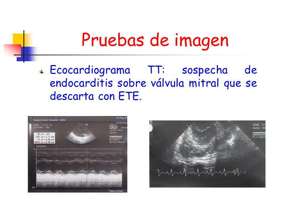 Pruebas de imagen Ecocardiograma TT: sospecha de endocarditis sobre válvula mitral que se descarta con ETE.