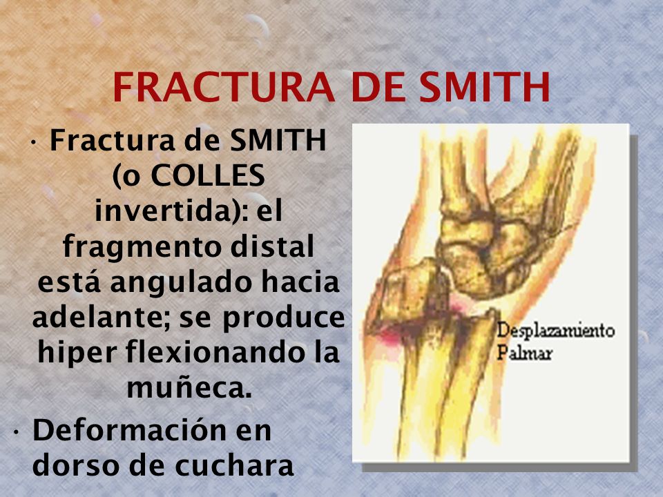 FRACTURA DE SMITH Fractura de SMITH (o COLLES invertida): el fragmento distal está angulado hacia adelante; se produce hiper flexionando la muñeca.