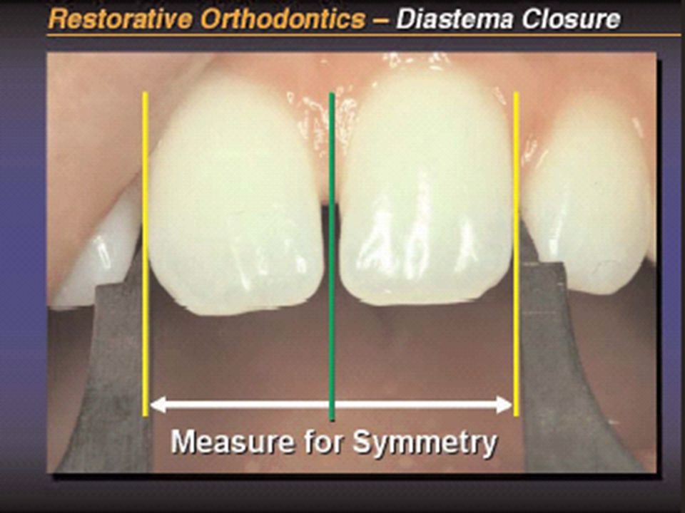 MEDIR DESDE DISTAL DE UN INCISVO CENTRAL HASTA EL PUNTO MAS DISTAL DEL CONTRALATERAL, SE DIVIDE ENTRE DOS Y SE DA LA MITAD PARA CADA UNO