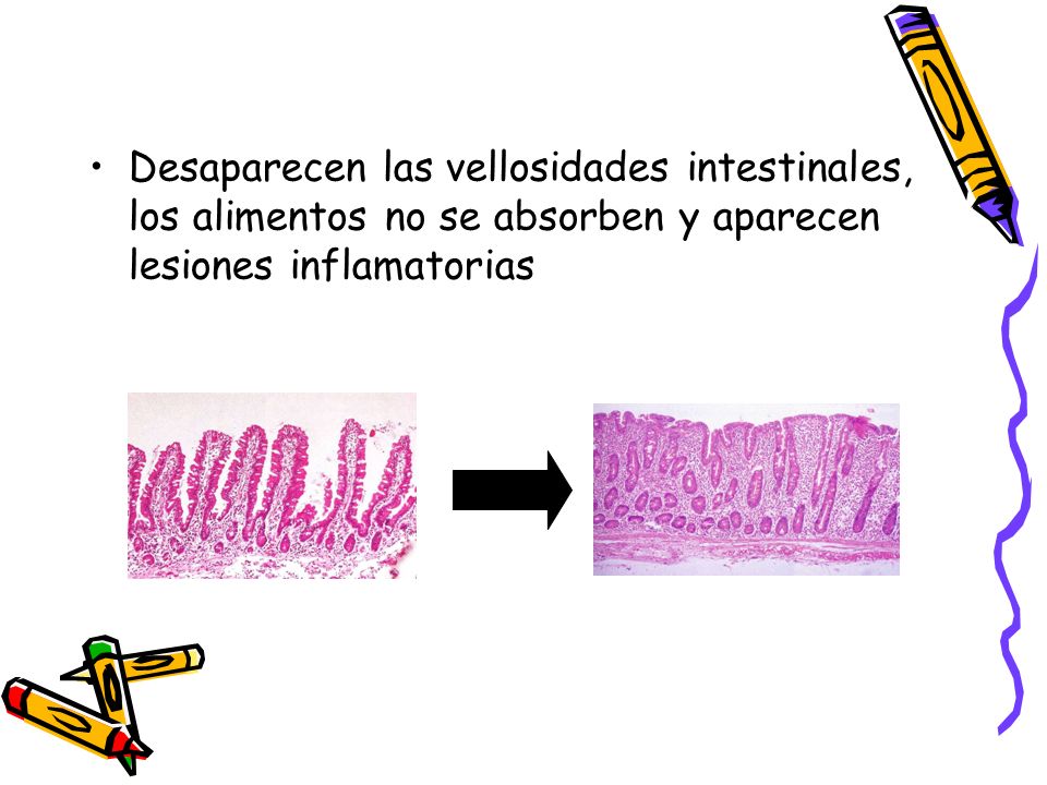 Desaparecen las vellosidades intestinales, los alimentos no se absorben y aparecen lesiones inflamatorias