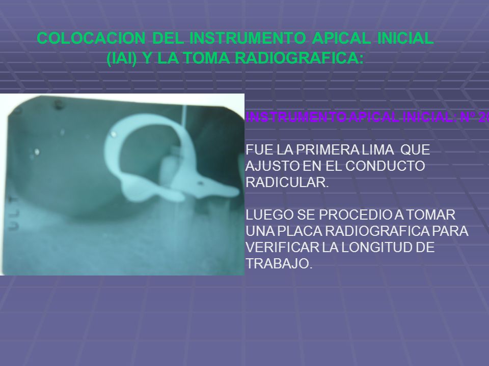 COLOCACION DEL INSTRUMENTO APICAL INICIAL (IAI) Y LA TOMA RADIOGRAFICA: