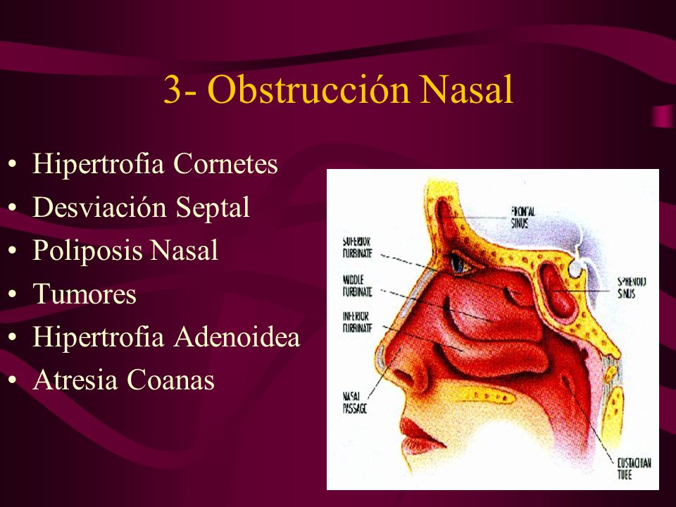 3- Obstrucción Nasal Hipertrofia Cornetes Desviación Septal