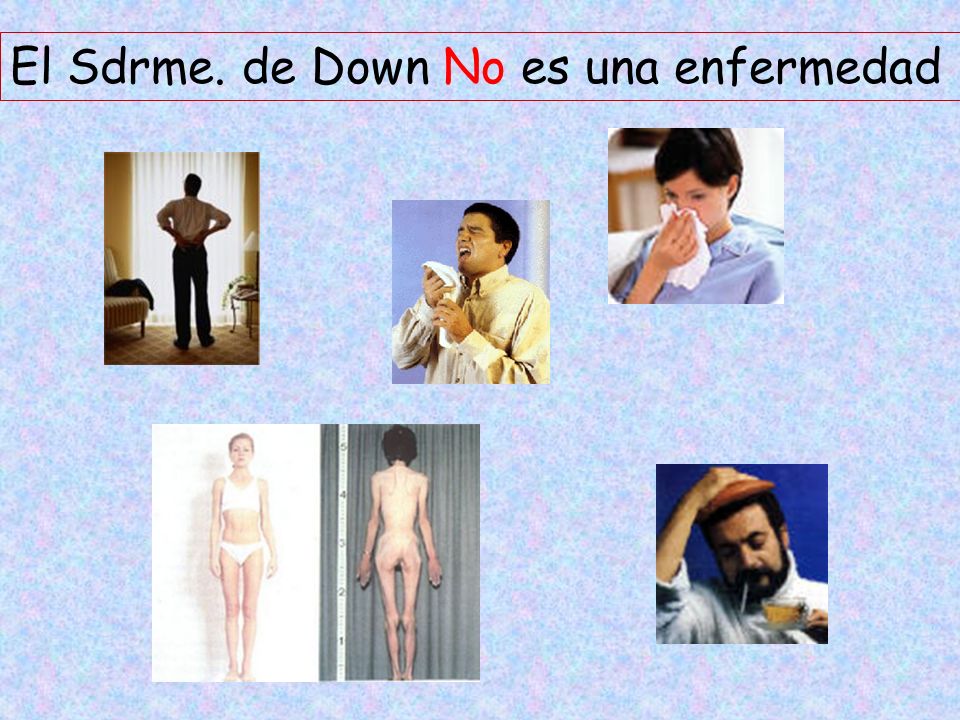 El Sdrme. de Down No es una enfermedad