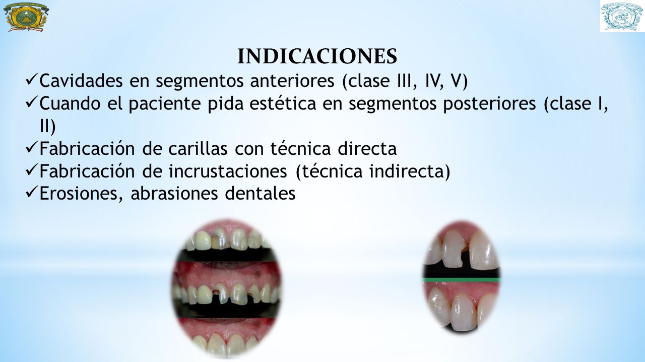 INDICACIONES Cavidades en segmentos anteriores (clase III, IV, V)