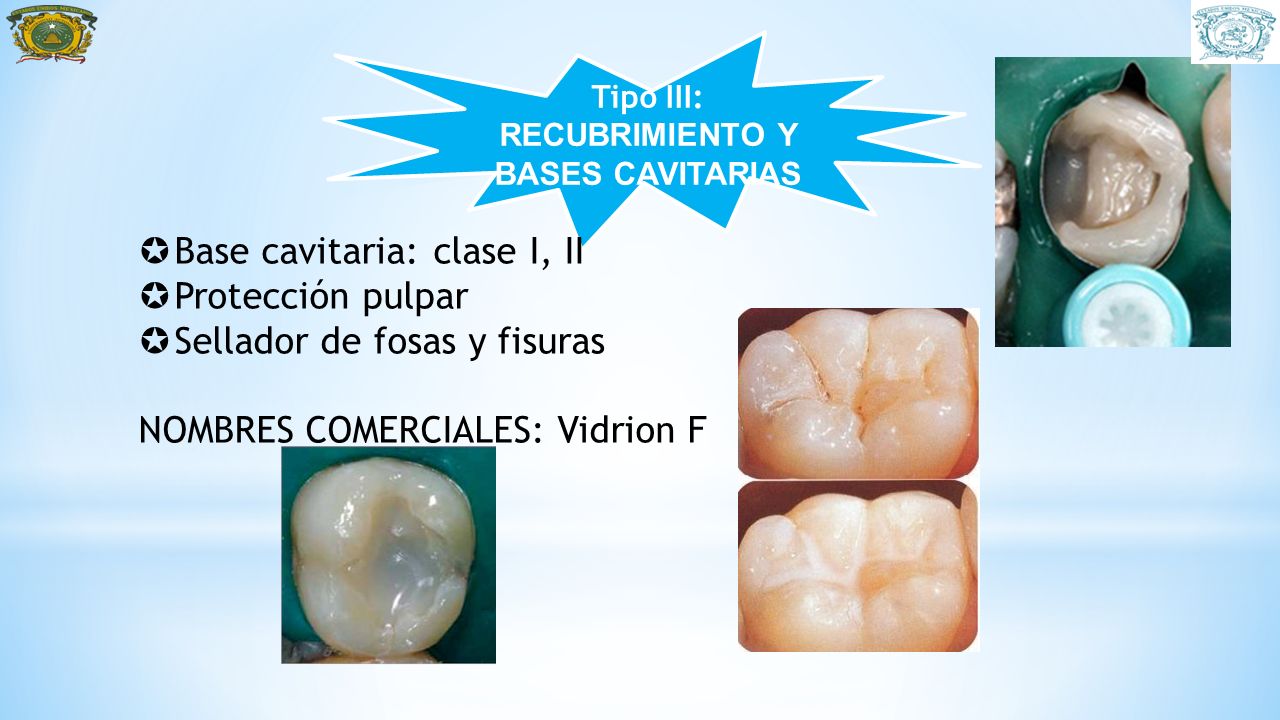 Tipo III: RECUBRIMIENTO Y BASES CAVITARIAS