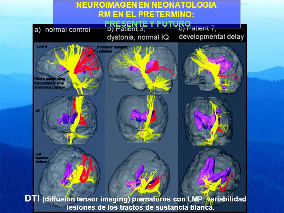 NEUROIMAGEN EN NEONATOLOGIA RM EN EL PRETERMINO: PRESENTE Y FUTURO