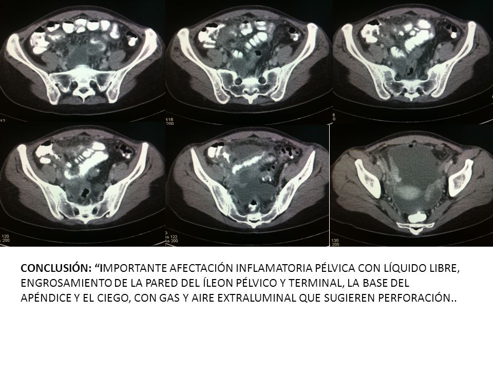 CONCLUSIÓN: IMPORTANTE AFECTACIÓN INFLAMATORIA PÉLVICA CON LÍQUIDO LIBRE, ENGROSAMIENTO DE LA PARED DEL ÍLEON PÉLVICO Y TERMINAL, LA BASE DEL APÉNDICE Y EL CIEGO, CON GAS Y AIRE EXTRALUMINAL QUE SUGIEREN PERFORACIÓN..