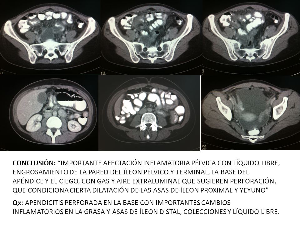 CONCLUSIÓN: IMPORTANTE AFECTACIÓN INFLAMATORIA PÉLVICA CON LÍQUIDO LIBRE, ENGROSAMIENTO DE LA PARED DEL ÍLEON PÉLVICO Y TERMINAL, LA BASE DEL APÉNDICE Y EL CIEGO, CON GAS Y AIRE EXTRALUMINAL QUE SUGIEREN PERFORACIÓN, QUE CONDICIONA CIERTA DILATACIÓN DE LAS ASAS DE ÍLEON PROXIMAL Y YEYUNO