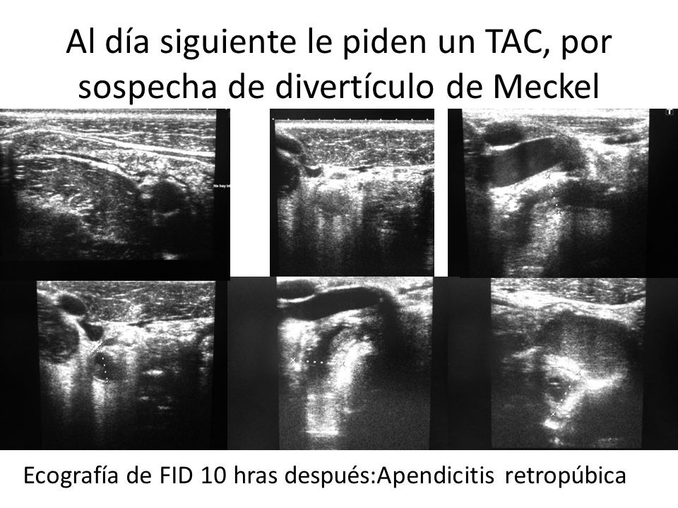 Al día siguiente le piden un TAC, por sospecha de divertículo de Meckel