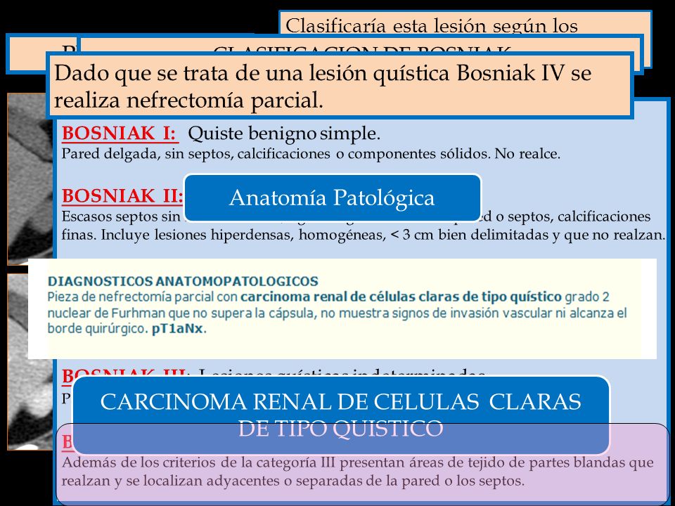 CARCINOMA RENAL DE CELULAS CLARAS DE TIPO QUISTICO A. Bosniak I