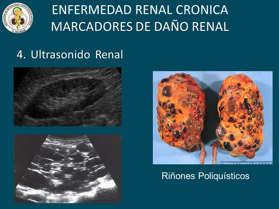 ENFERMEDAD RENAL CRONICA MARCADORES DE DAÑO RENAL