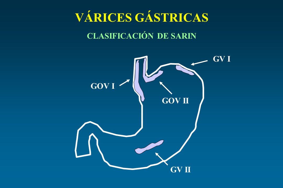 VÁRICES GÁSTRICAS CLASIFICACIÓN DE SARIN GV I GOV I GOV II GV II