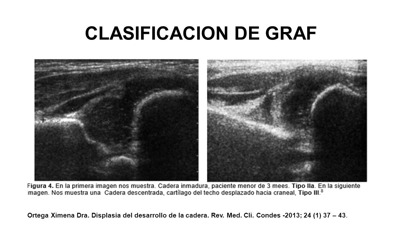 CLASIFICACION DE GRAF Ortega Ximena Dra. Displasia del desarrollo de la cadera.