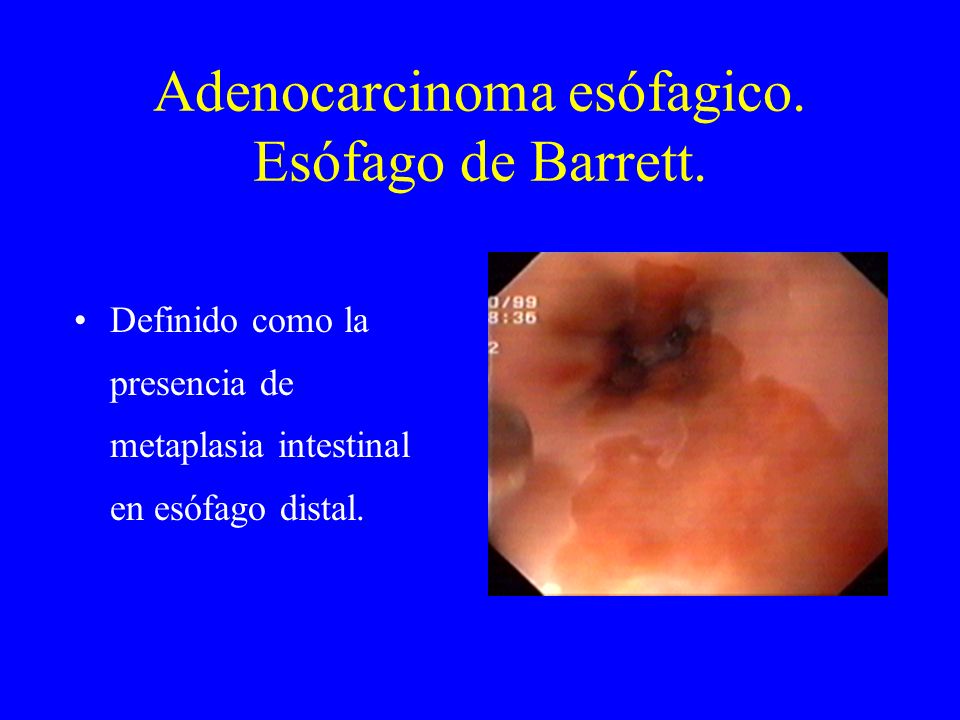 Adenocarcinoma esófagico. Esófago de Barrett.