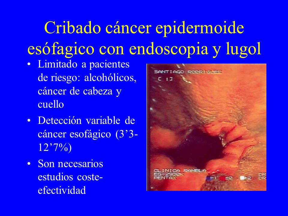 Cribado cáncer epidermoide esófagico con endoscopia y lugol