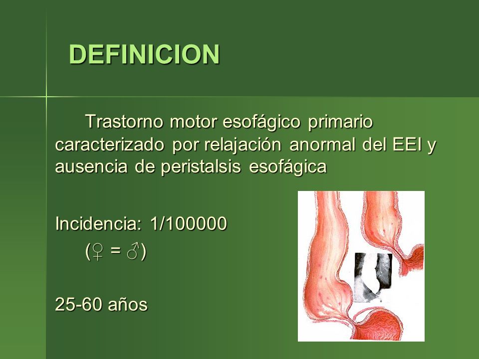 DEFINICION Trastorno motor esofágico primario caracterizado por relajación anormal del EEI y ausencia de peristalsis esofágica.