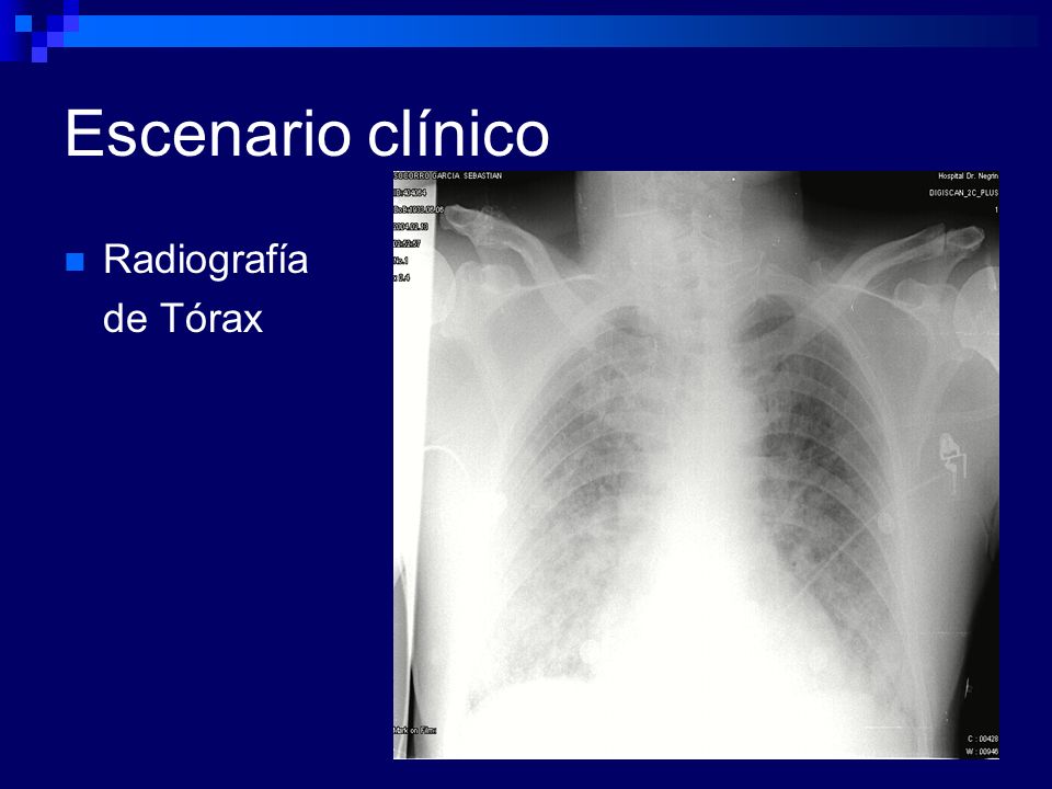 Escenario clínico Radiografía de Tórax