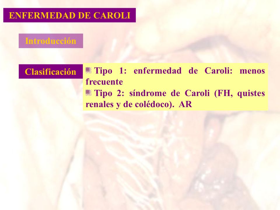 ENFERMEDAD DE CAROLI Introducción. Clasificación. Tipo 1: enfermedad de Caroli: menos frecuente.
