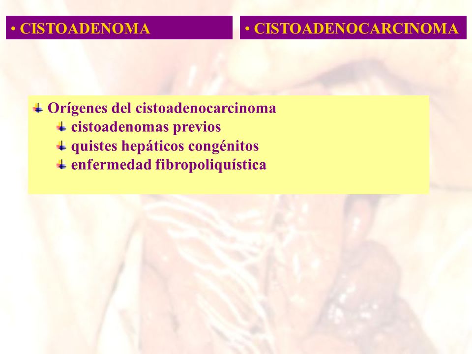 CISTOADENOMA CISTOADENOCARCINOMA. Orígenes del cistoadenocarcinoma. cistoadenomas previos. quistes hepáticos congénitos.