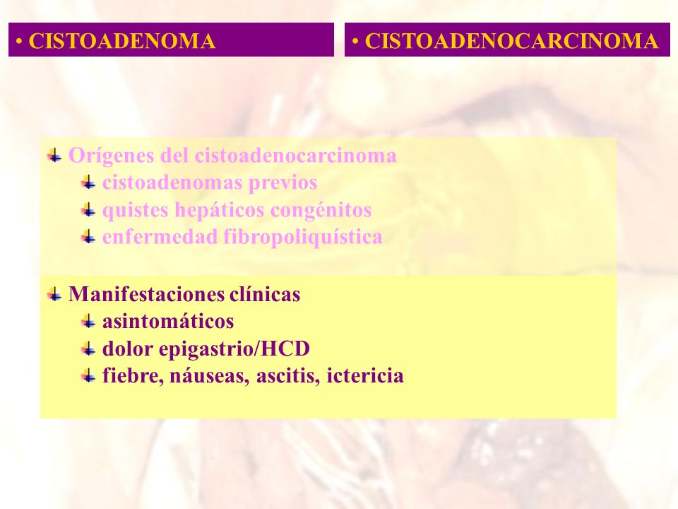 CISTOADENOMA CISTOADENOCARCINOMA. Orígenes del cistoadenocarcinoma. cistoadenomas previos. quistes hepáticos congénitos.