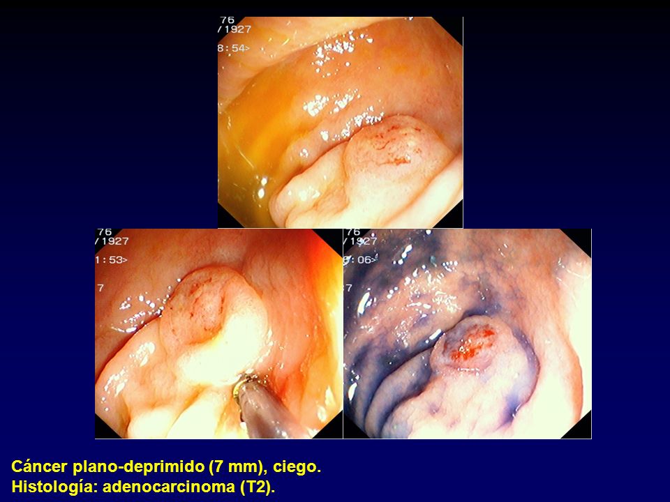 Cáncer plano-deprimido (7 mm), ciego. Histología: adenocarcinoma (T2).
