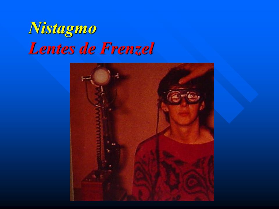 Nistagmo Lentes de Frenzel