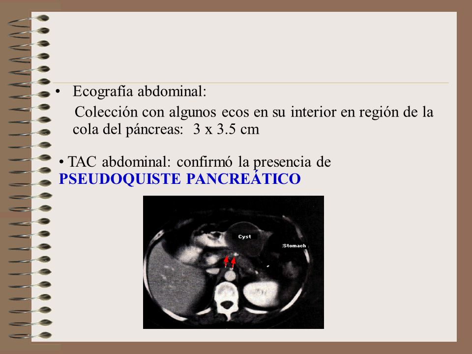 Ecografía abdominal: Colección con algunos ecos en su interior en región de la cola del páncreas: 3 x 3.5 cm.