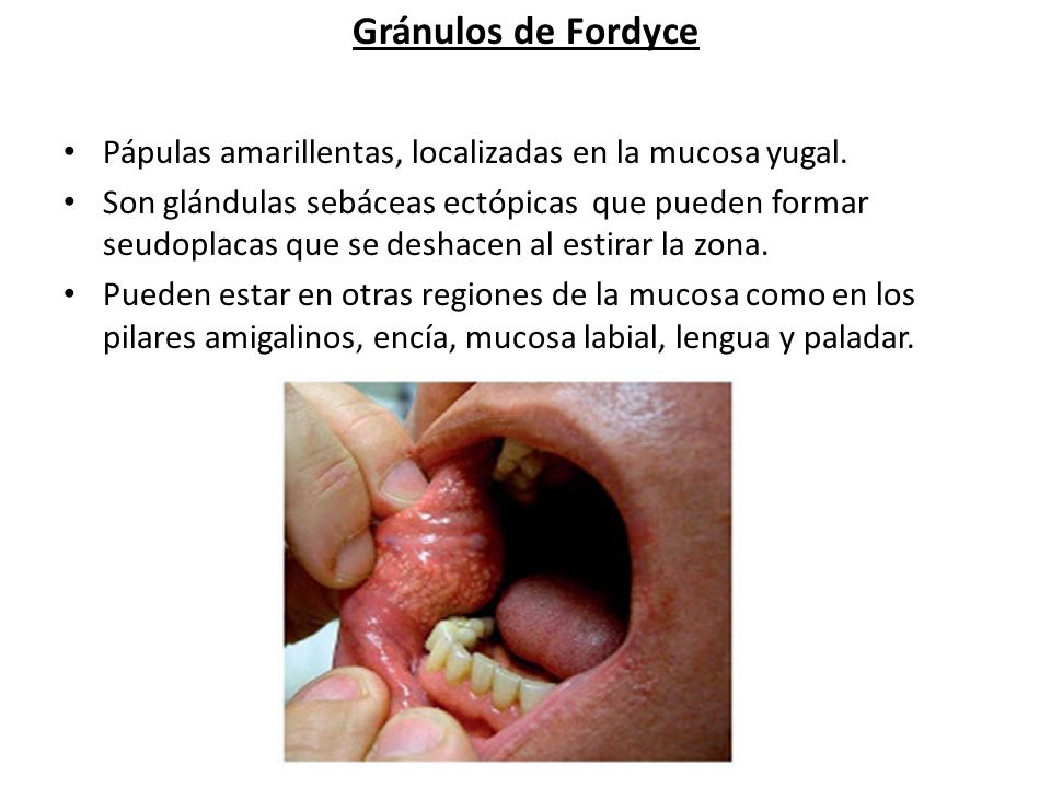 Gránulos de Fordyce Pápulas amarillentas, localizadas en la mucosa yugal.